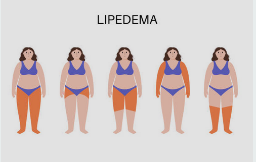 Can You Get Rid Of Lipedema?